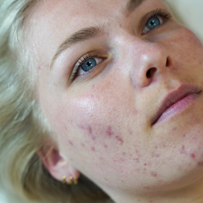 Acne: wat is het en wat kun je er tegen doen?